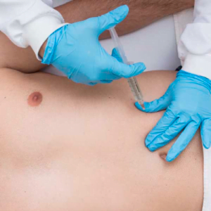 Intradermoterapia de enzima