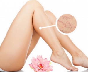 PEIM ( Aplicação de varizes )